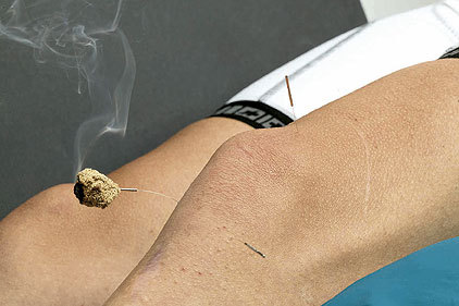 acupuncture acupuncture